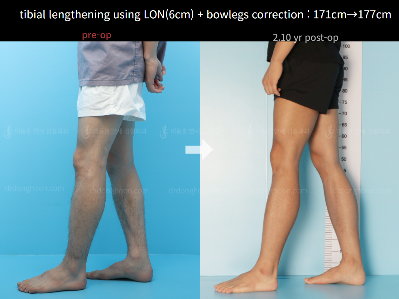 Before and after cll + deformity correction, case 7601278, image 3, Dr. Donghoon institute (DALRI)