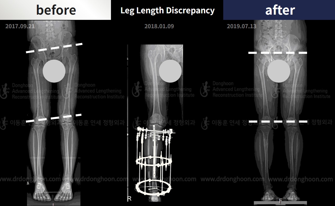 Before and after adult lld, case 4320305, image 3, Dr. Donghoon institute (DALRI)