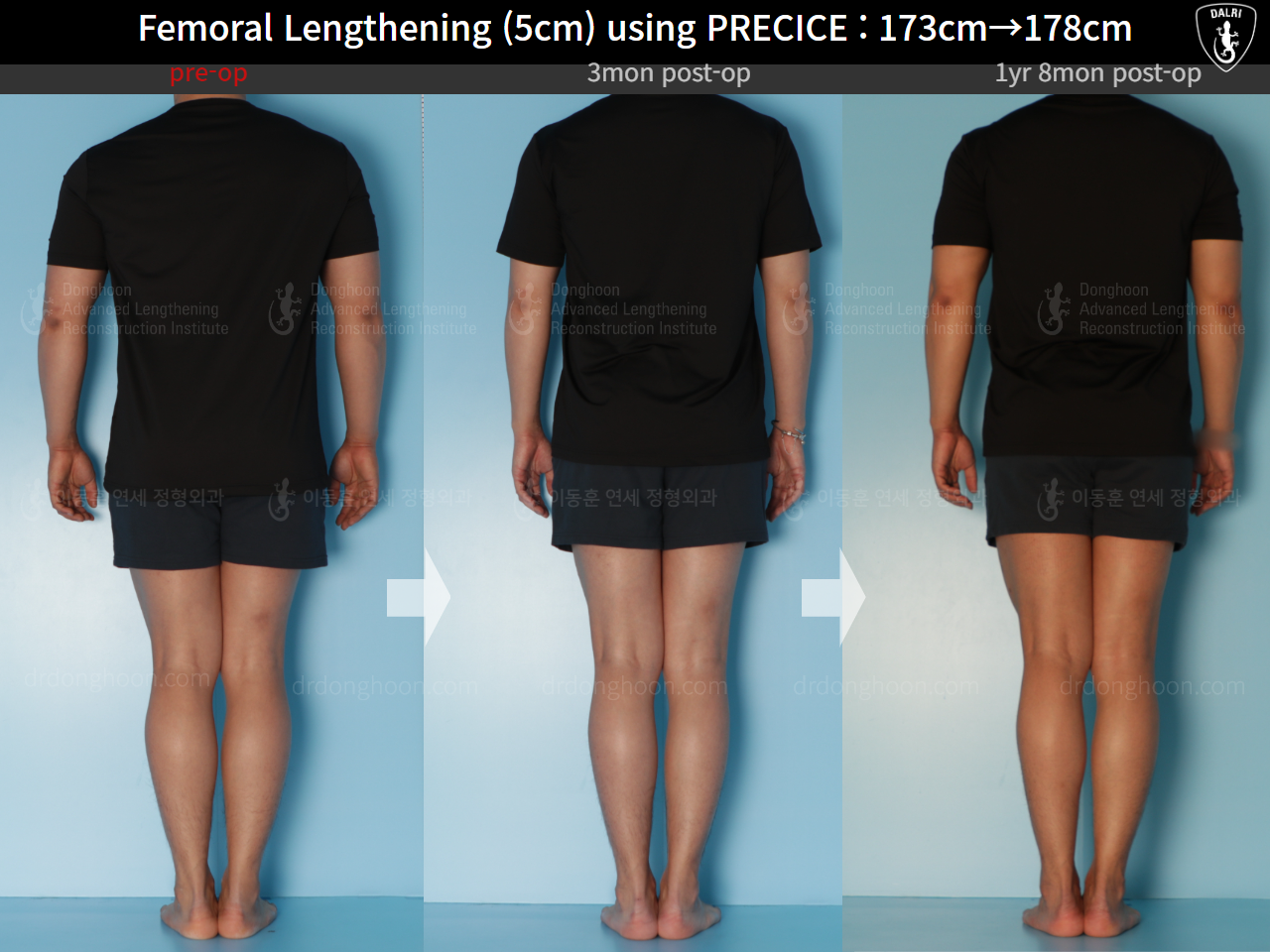 Before and after cll precice, case 21702609, image 2, Dr. Donghoon institute (DALRI)