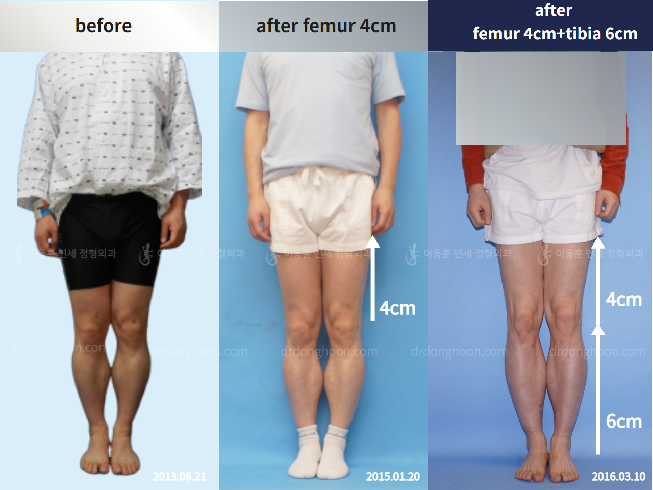 Before and after cll precice, case 4323434, image 1, Dr. Donghoon institute (DALRI)
