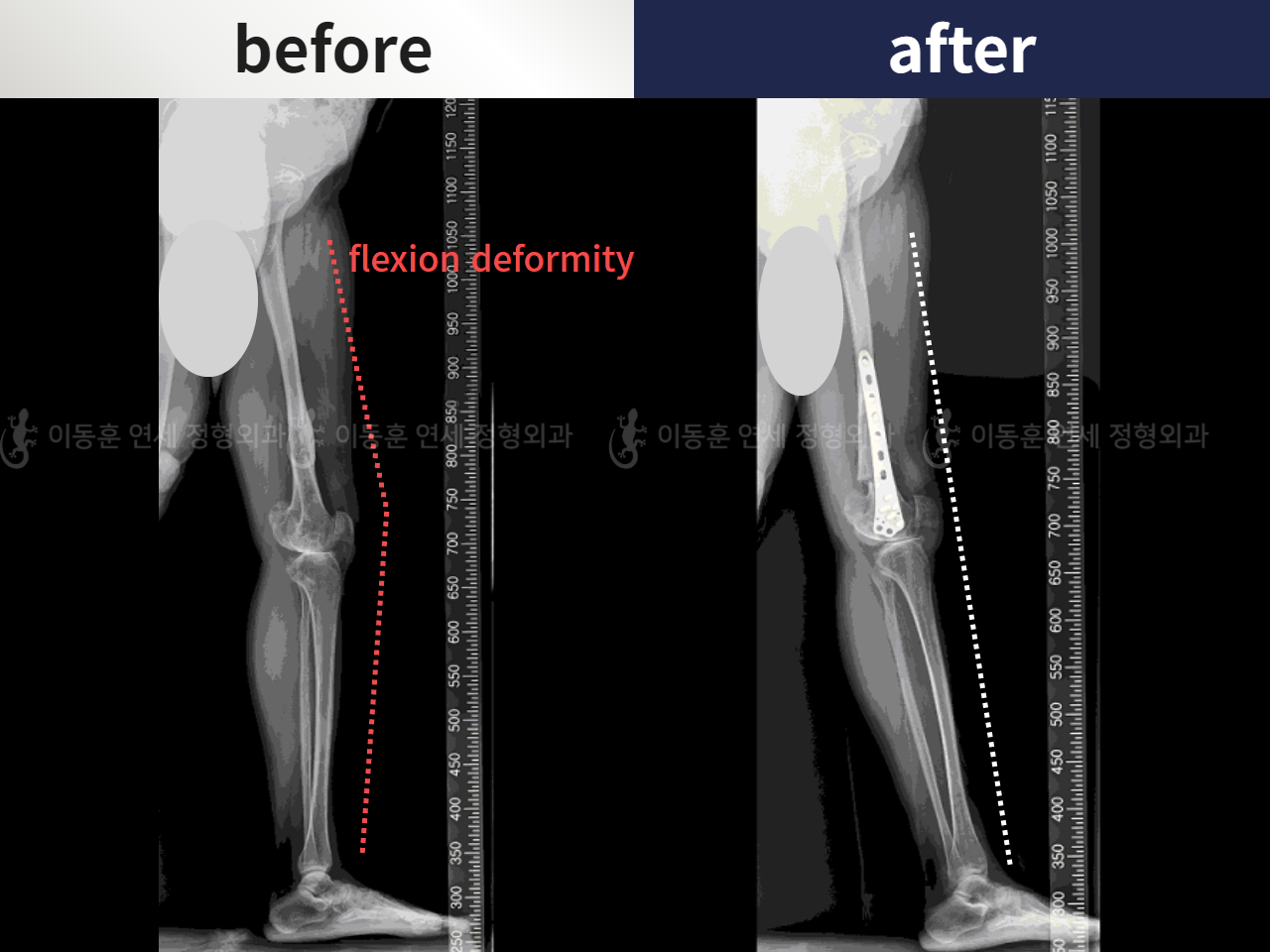 Before and after adult bowlegs, case 5987521, image 3, Dr. Donghoon institute (DALRI)