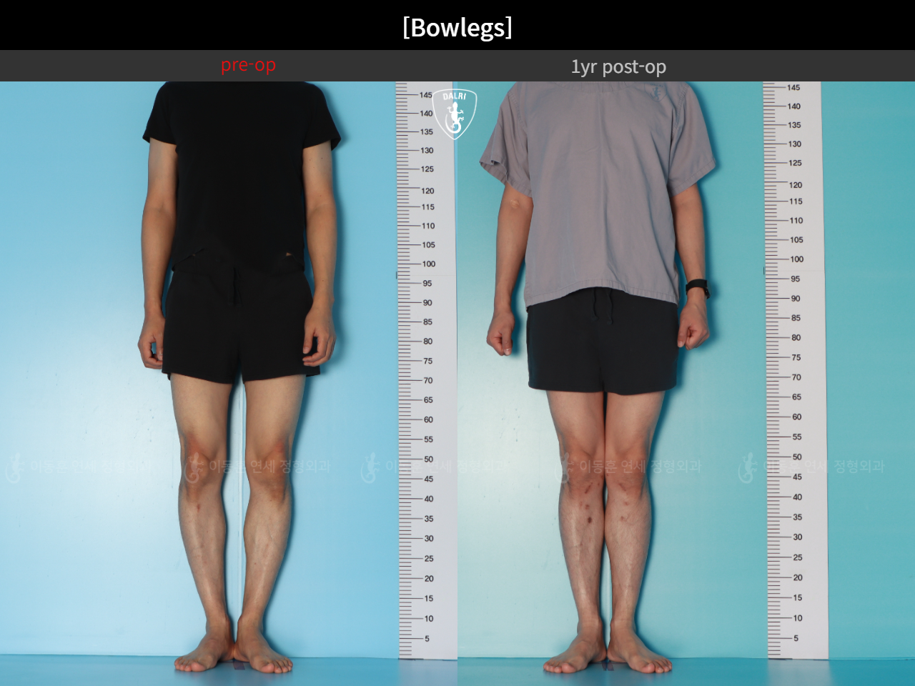 Before and after adult bowlegs, case 32564251, image 6, Dr. Donghoon institute (DALRI)