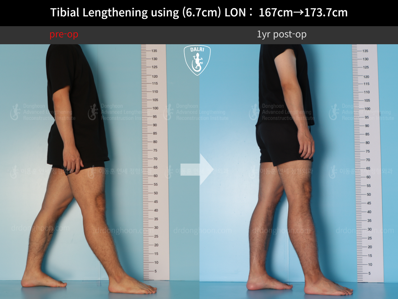 Before and after cll lon, case 12426969, image 3, Dr. Donghoon institute (DALRI)