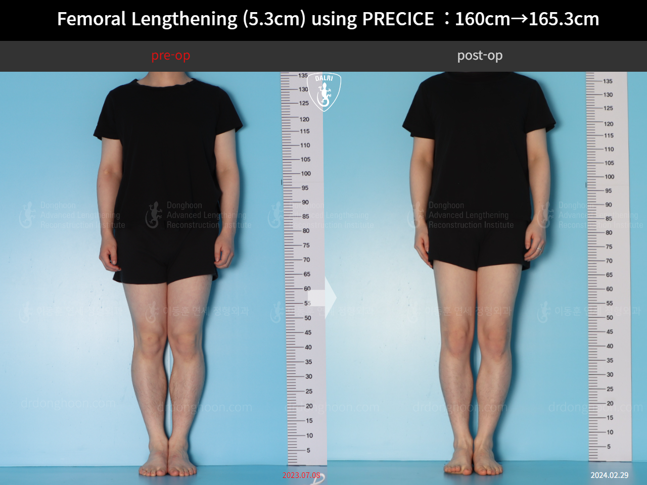 Before and after cll precice, case 18250566, image 1, Dr. Donghoon institute (DALRI)