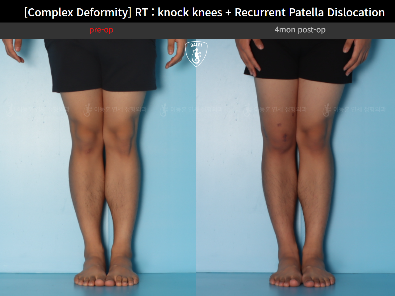 Before and after adult knock knees, case 125841800, image 6, Dr. Donghoon institute (DALRI)