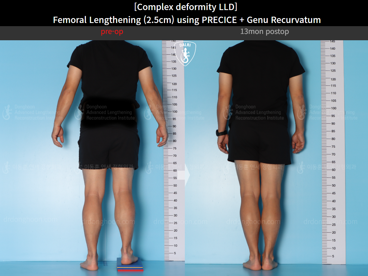 Before and after genu recurvatum, case 16854701, image 2, Dr. Donghoon institute (DALRI)