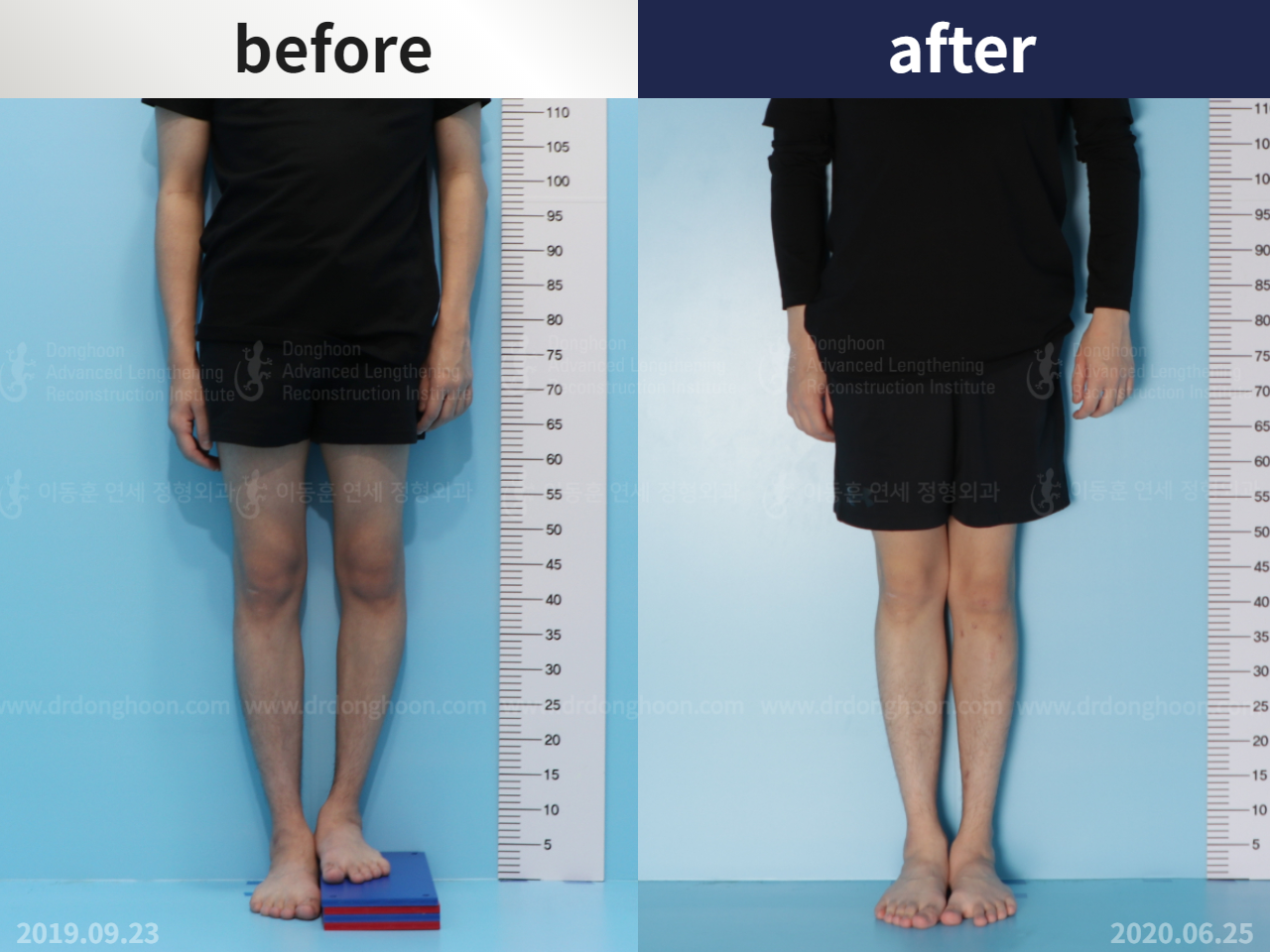 Before and after paediatric & adolescent lld, case 4684461, image 2, Dr. Donghoon institute (DALRI)