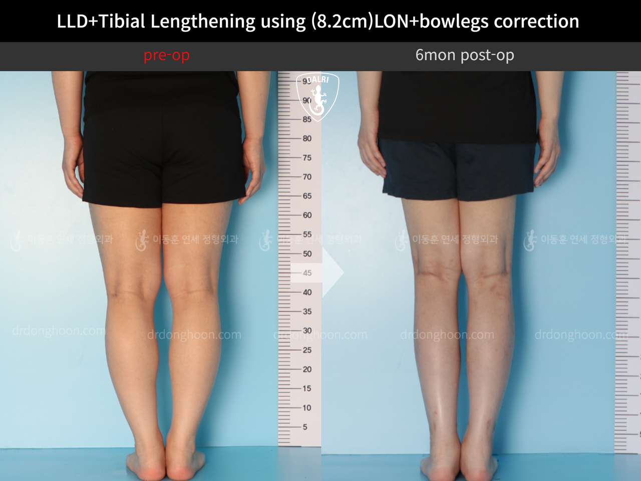 Before and after cll + deformity correction, case 12782230, image 4, Dr. Donghoon institute (DALRI)