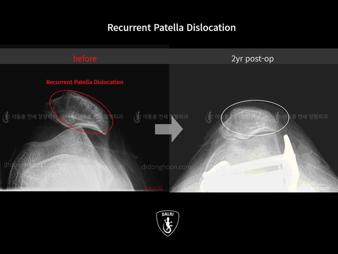 Before and after recurrent patella dislocation, case 10329296, image 4, Dr. Donghoon institute (DALRI)