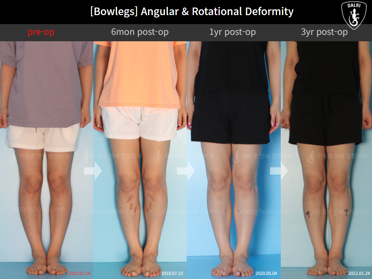Before and after adult bowlegs, case 9678047, image 1, Dr. Donghoon institute (DALRI)