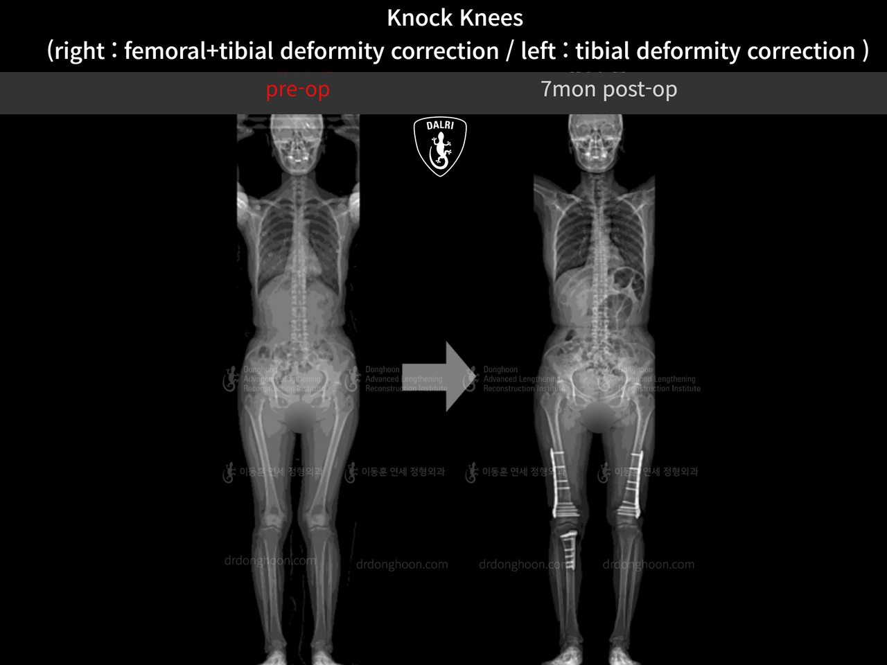 Before and after adult knock knees, case 13229486, image 1, Dr. Donghoon institute (DALRI)