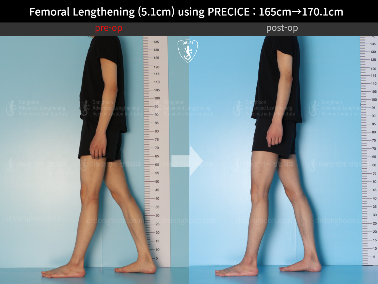 Before and after cll precice, case 13184743, image 4, Dr. Donghoon institute (DALRI)
