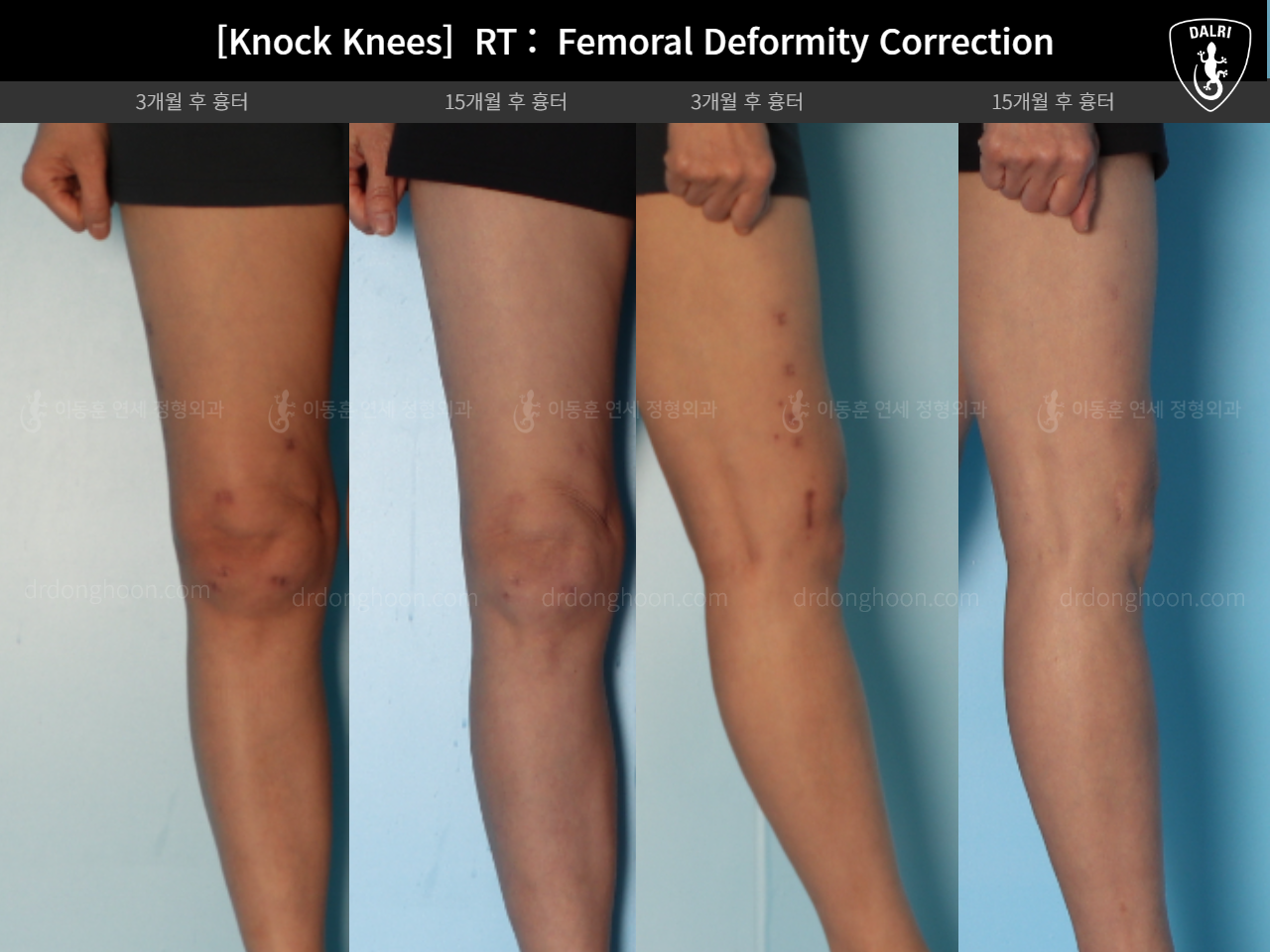 Before and after adult knock knees, case 14462642, image 9, Dr. Donghoon institute (DALRI)