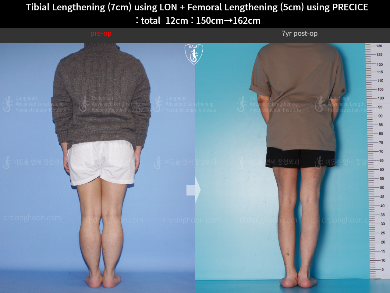 Before and after cll precice, case 16146445, image 6, Dr. Donghoon institute (DALRI)
