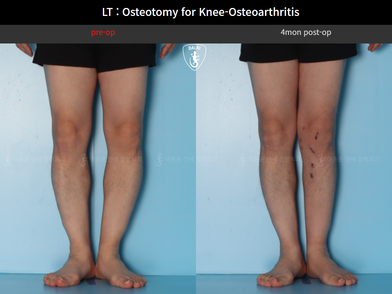 Before and after osteotomy for knee osteoarthritis, case 128374850, image 7, Dr. Donghoon institute (DALRI)