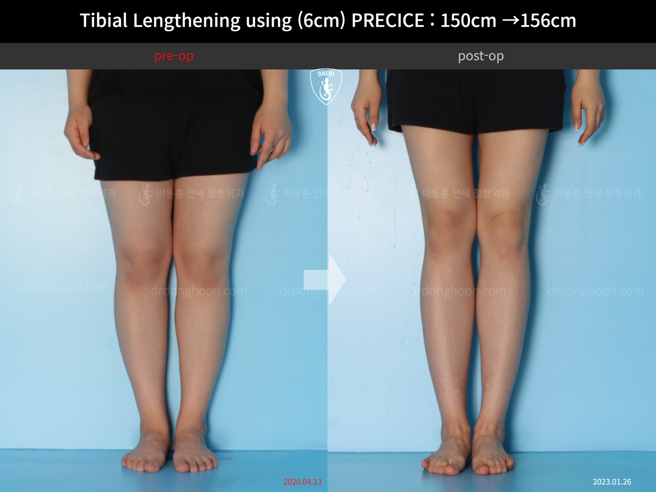 Before and after cll precice, case 14065180, image 5, Dr. Donghoon institute (DALRI)