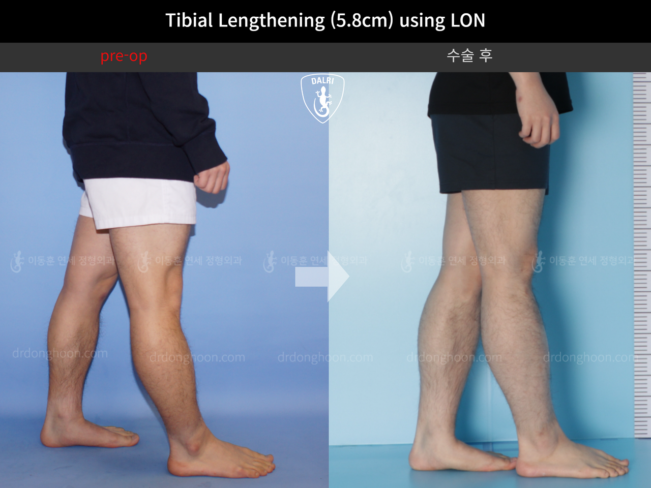 Before and after cll lon, case 4577732, image 8, Dr. Donghoon institute (DALRI)