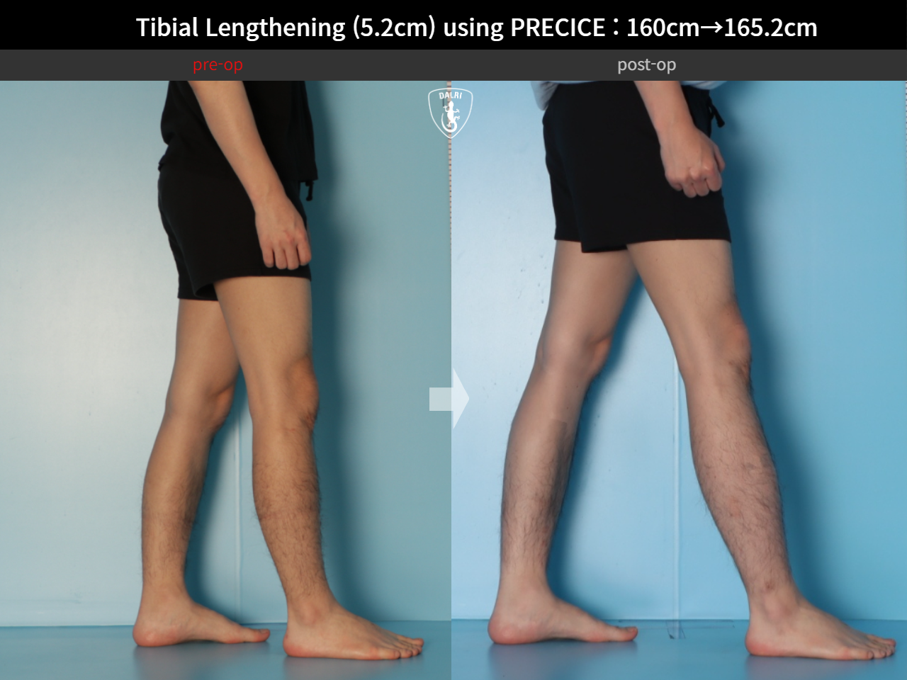Before and after cll precice, case 27370351, image 7, Dr. Donghoon institute (DALRI)