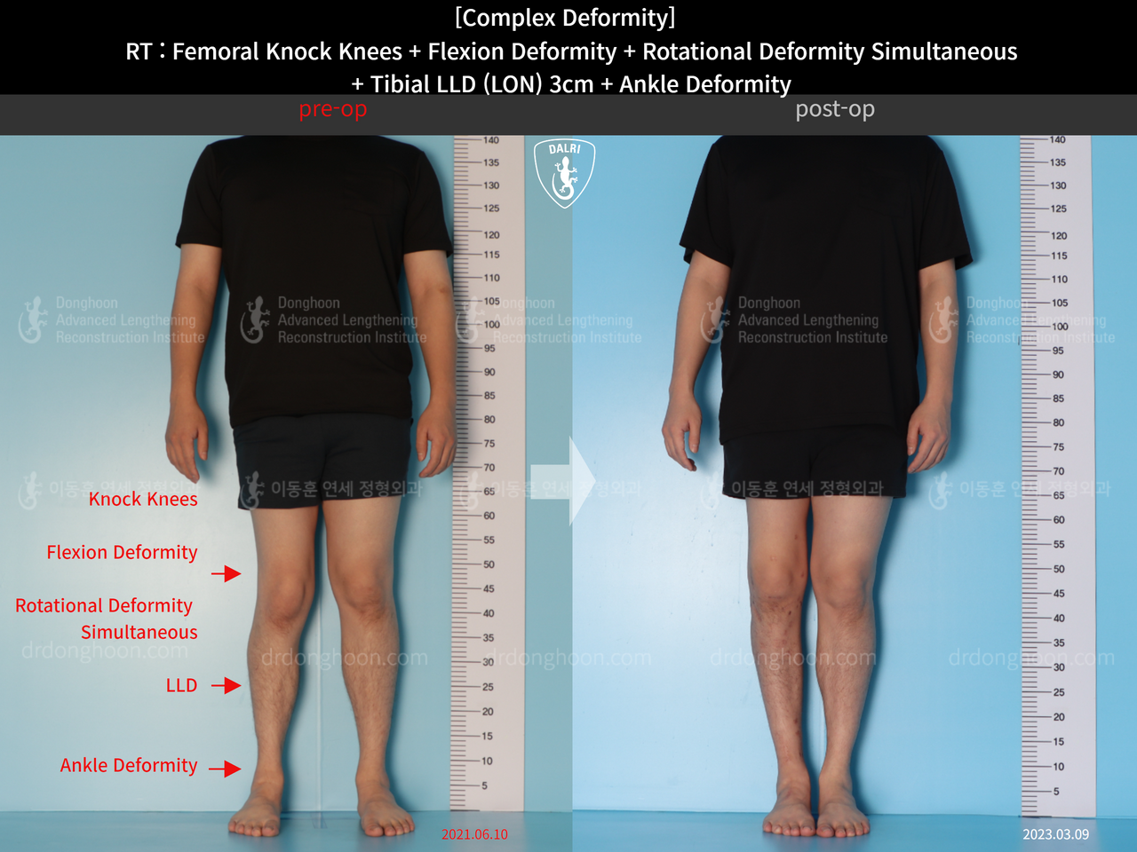 Before and after complex deformity, case 14286599, image 1, Dr. Donghoon institute (DALRI)