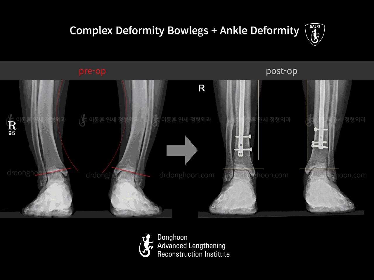 Before and after foot & ankle deformity, case 13215121, image 2, Dr. Donghoon institute (DALRI)