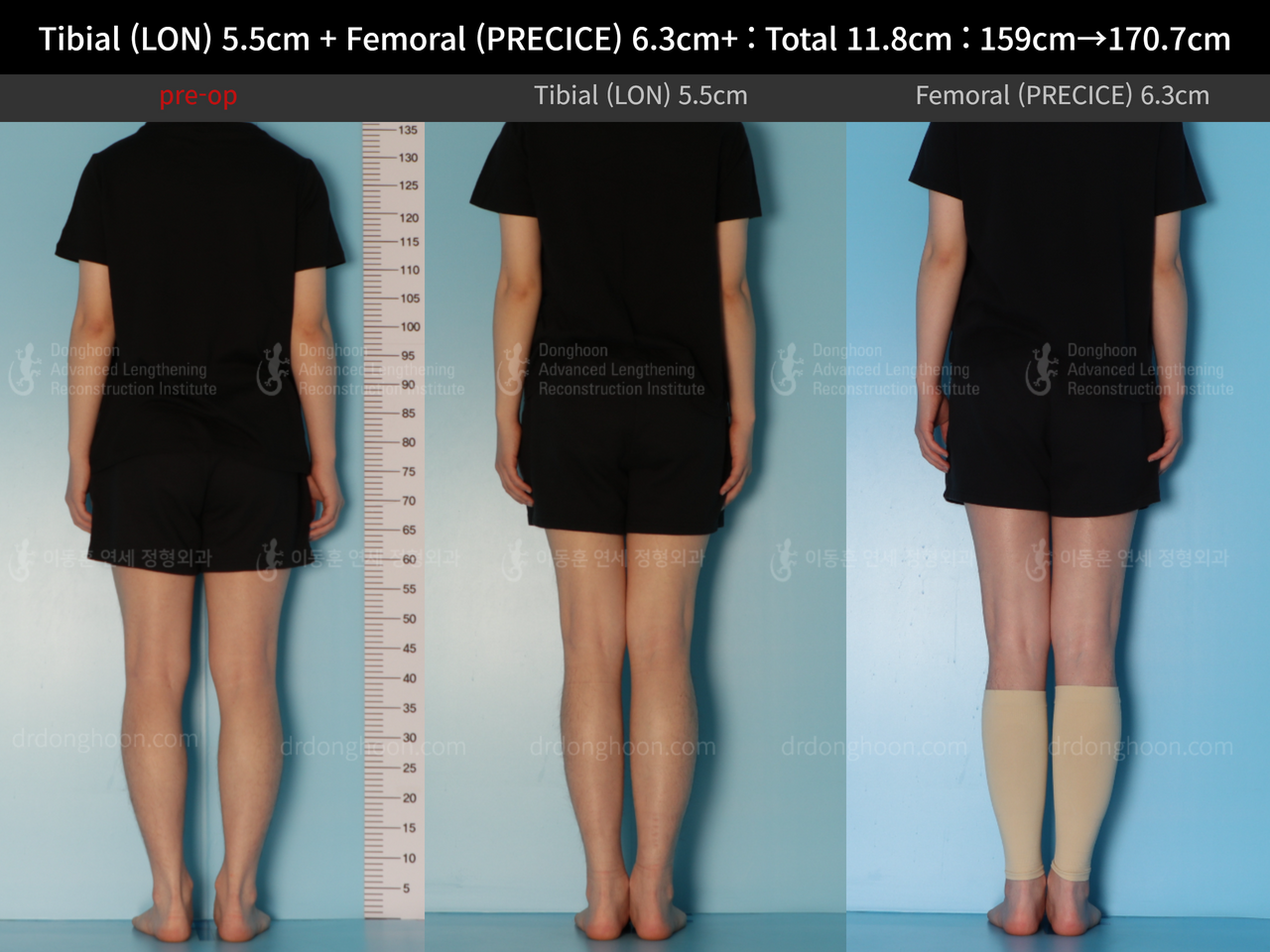 Before and after cll lon, case 14390077, image 2, Dr. Donghoon institute (DALRI)