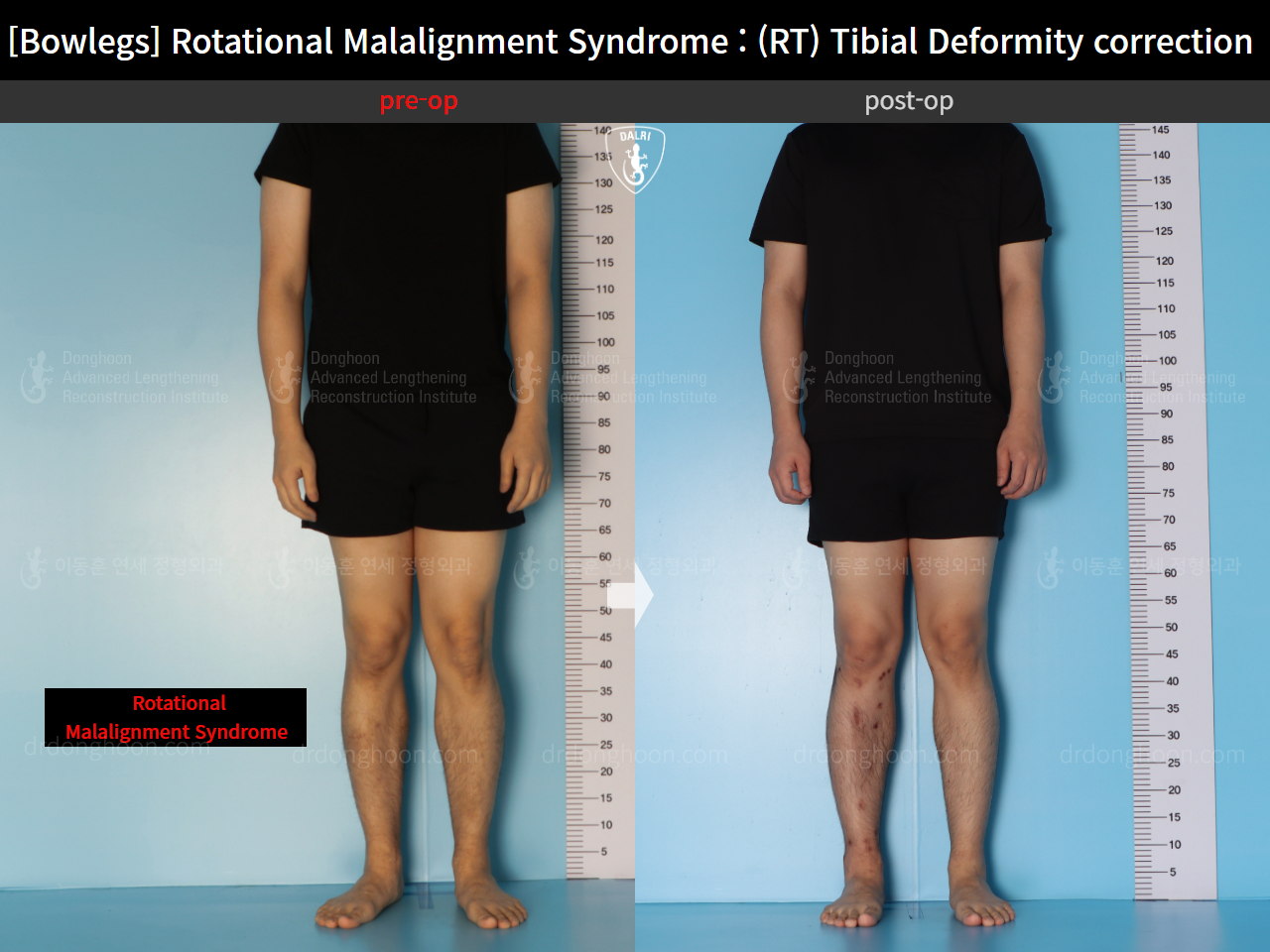 Before and after adult bowlegs, case 16482195, image 2, Dr. Donghoon institute (DALRI)