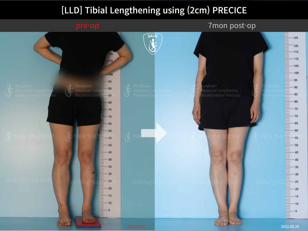 Before and after adult lld, case 12985023, image 1, Dr. Donghoon institute (DALRI)