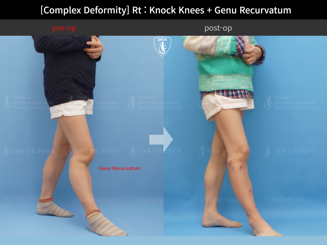Before and after complex deformity, case 13204696, image 4, Dr. Donghoon institute (DALRI)