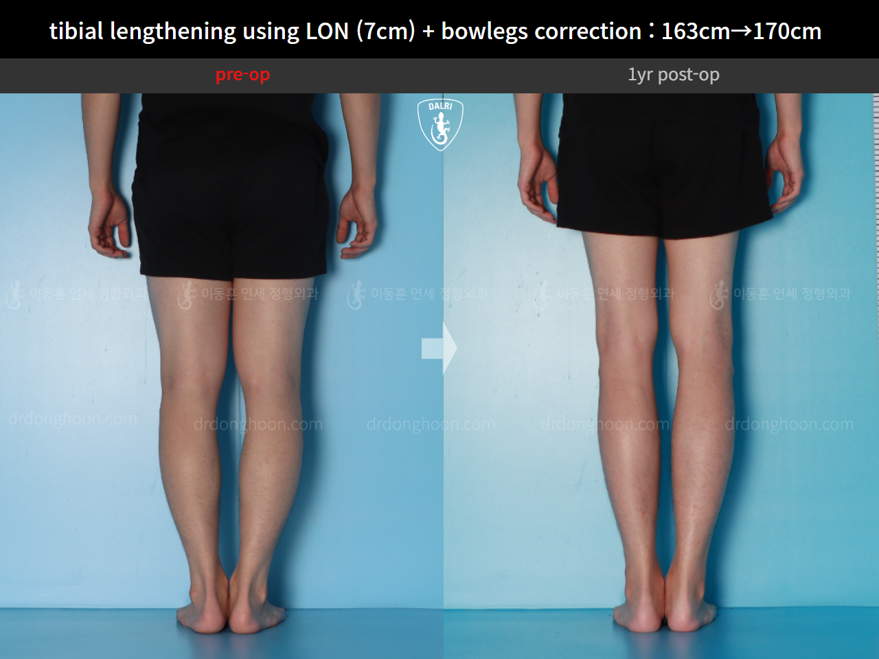 Before and after cll lon, case 16131902, image 10, Dr. Donghoon institute (DALRI)