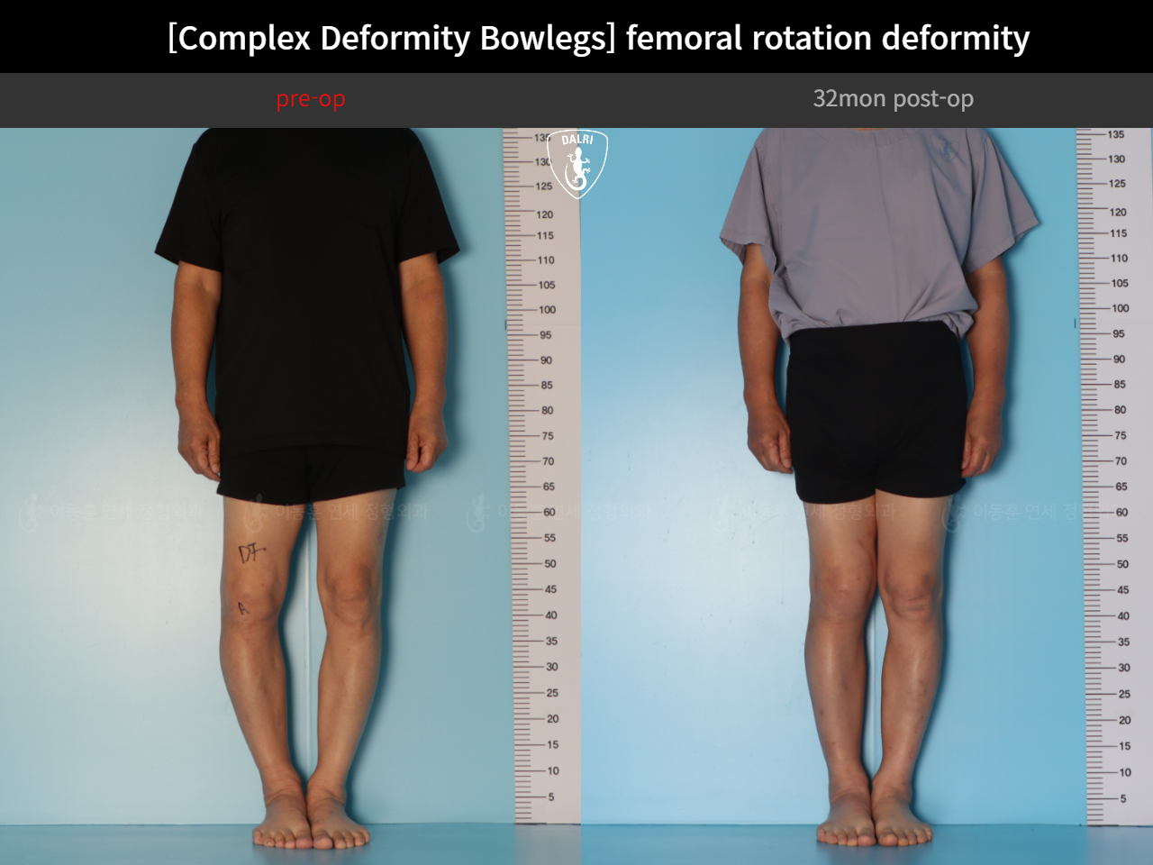 Before and after adult bowlegs, case 35242887, image 3, Dr. Donghoon institute (DALRI)