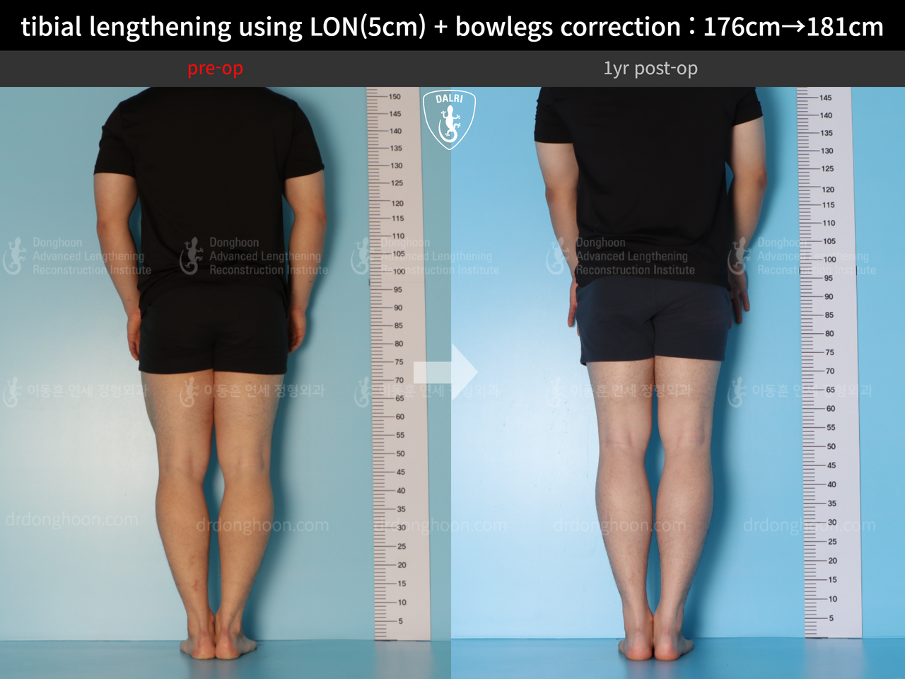 Before and after cll + deformity correction, case 13410849, image 3, Dr. Donghoon institute (DALRI)
