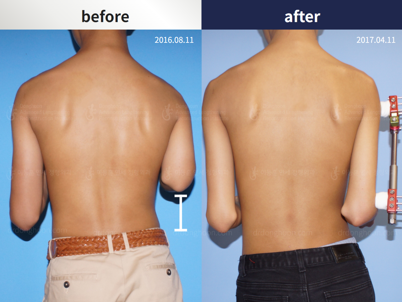 Before and after arm lengthening, case 4249350, image 2, Dr. Donghoon institute (DALRI)