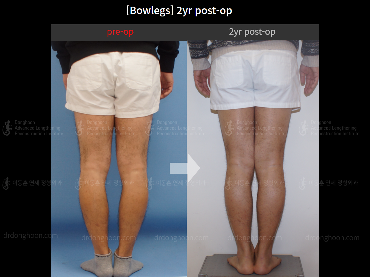 Before and after adult bowlegs, case 4311027, image 4, Dr. Donghoon institute (DALRI)