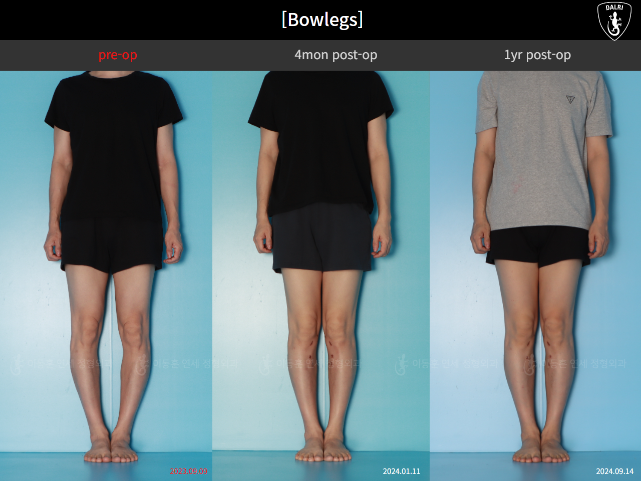 Before and after adult bowlegs, case 125438866, image 1, Dr. Donghoon institute (DALRI)