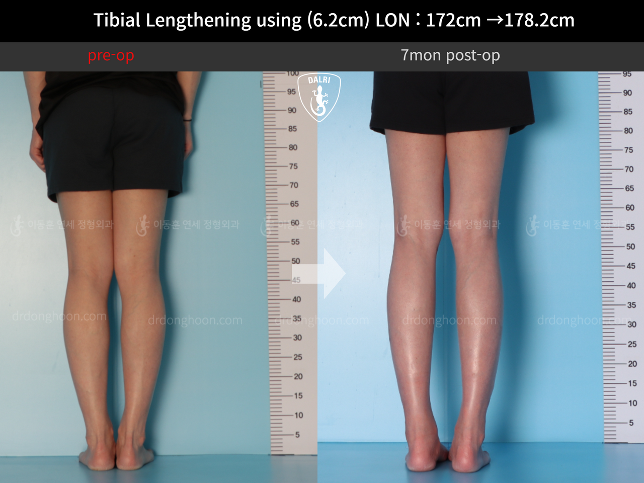 Before and after cll lon, case 12519142, image 6, Dr. Donghoon institute (DALRI)
