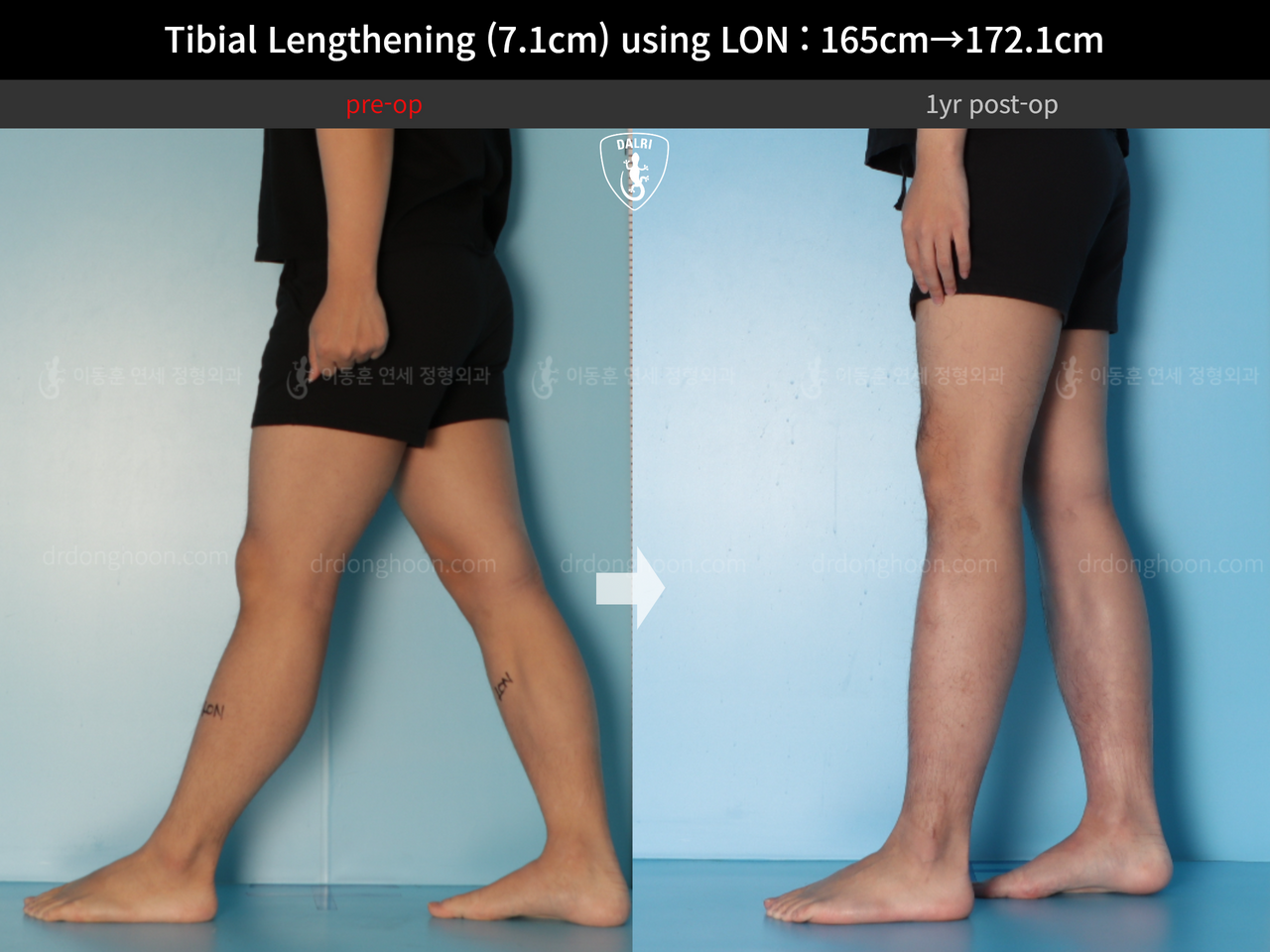 Before and after cll lon, case 14318674, image 10, Dr. Donghoon institute (DALRI)