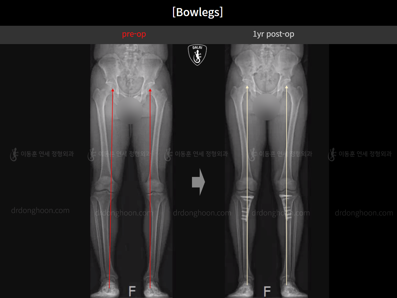 Before and after adult bowlegs, case 16724494, image 13, Dr. Donghoon institute (DALRI)