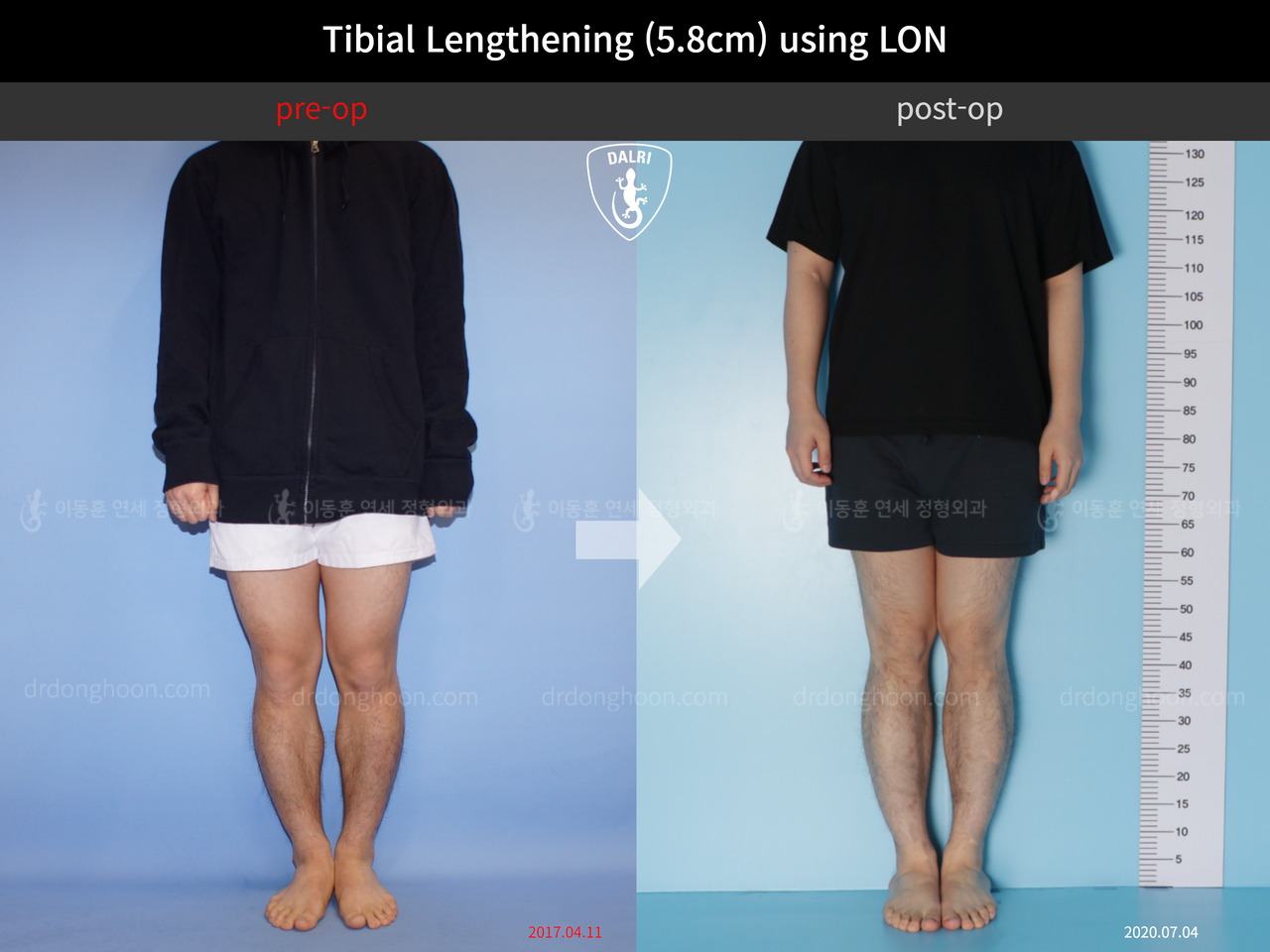 Before and after cll lon, case 4577732, image 1, Dr. Donghoon institute (DALRI)
