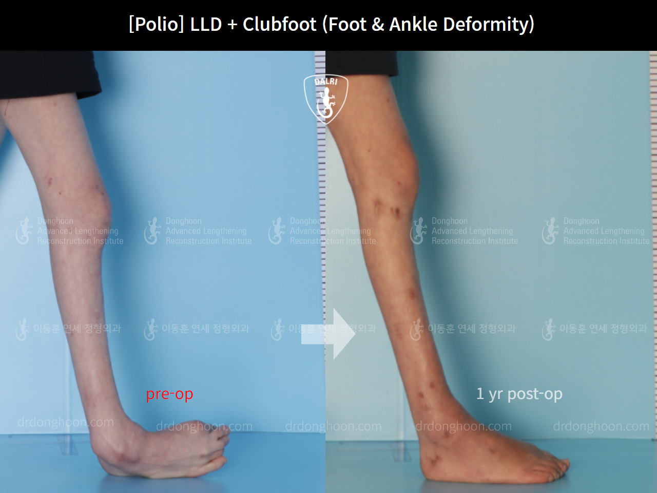 Before and after congenital clubfoot, case 9231529, image 3, Dr. Donghoon institute (DALRI)