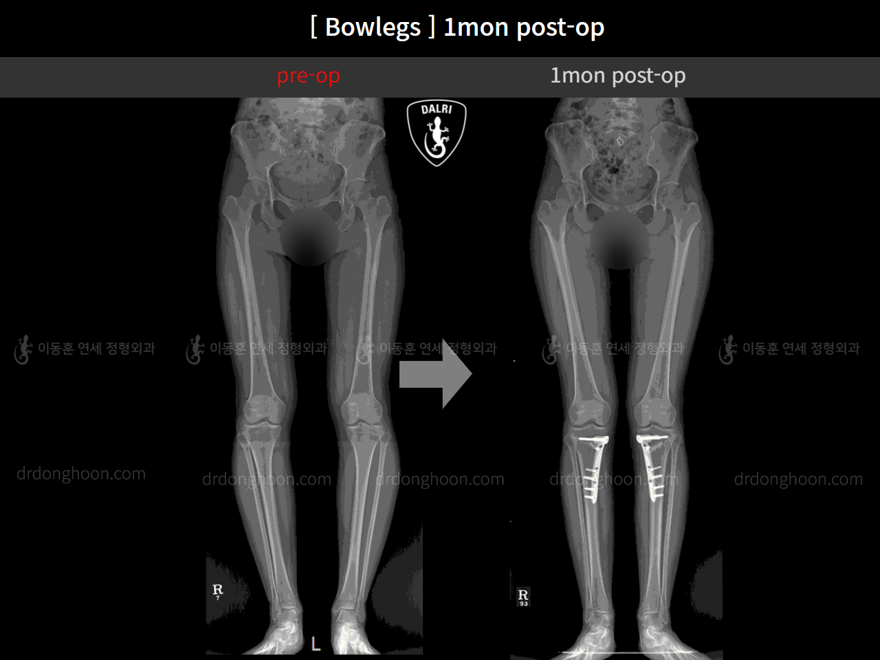 Before and after adult bowlegs, case 11773540, image 3, Dr. Donghoon institute (DALRI)