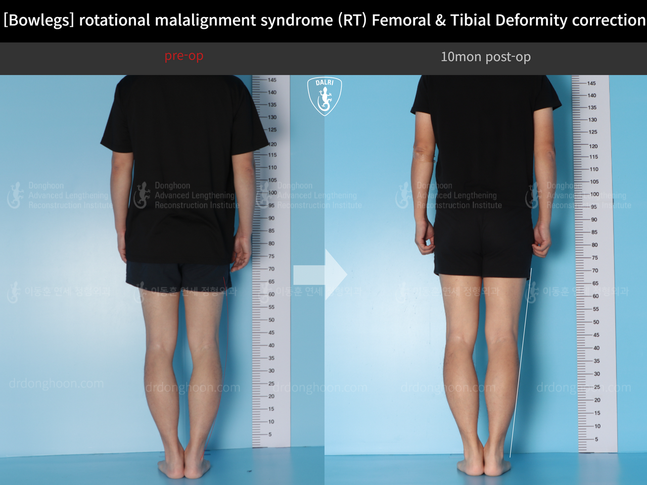 Before and after adult bowlegs, case 14220550, image 3, Dr. Donghoon institute (DALRI)
