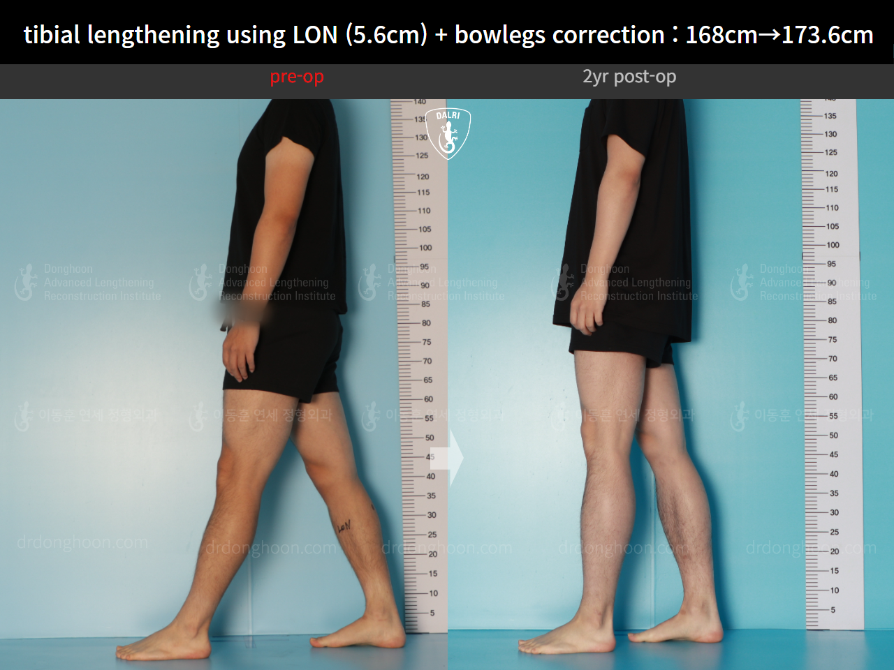 Before and after cll + deformity correction, case 17361975, image 4, Dr. Donghoon institute (DALRI)