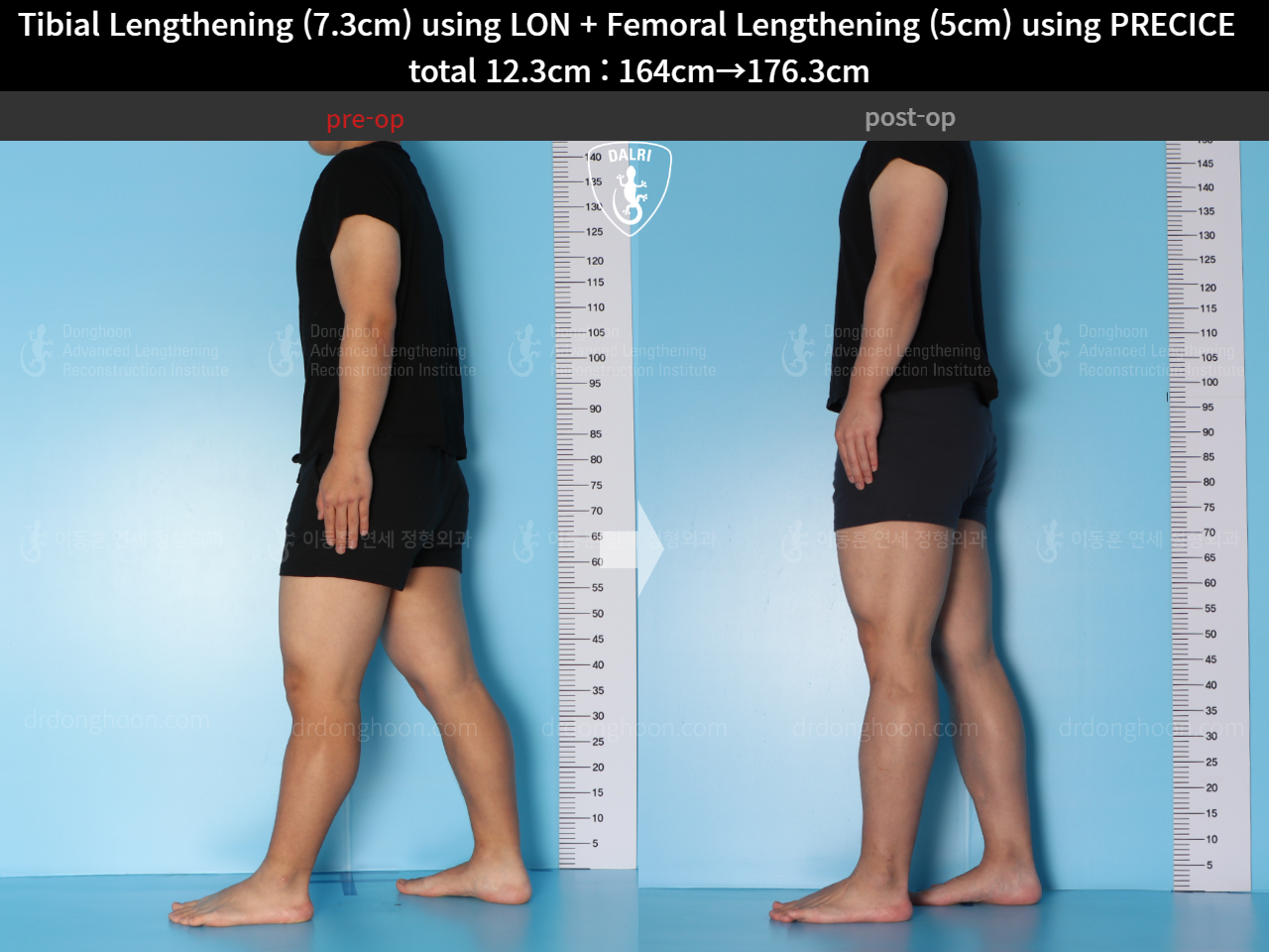 Before and after cll precice, case 15592732, image 4, Dr. Donghoon institute (DALRI)