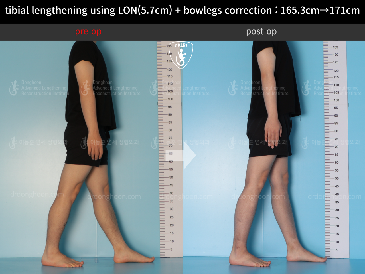 Before and after cll + deformity correction, case 12679153, image 4, Dr. Donghoon institute (DALRI)