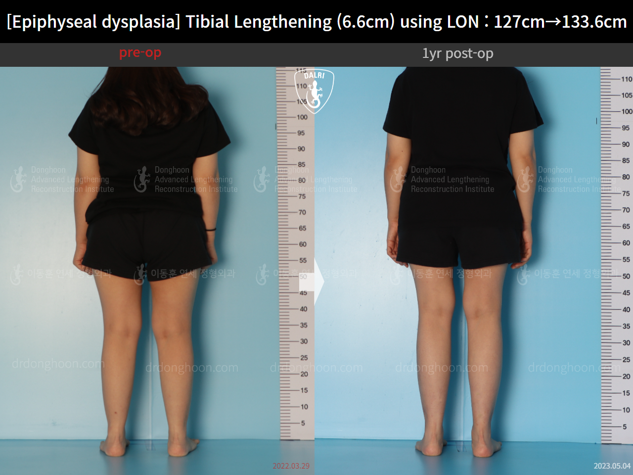 Before and after congenital condition, case 15072062, image 4, Dr. Donghoon institute (DALRI)