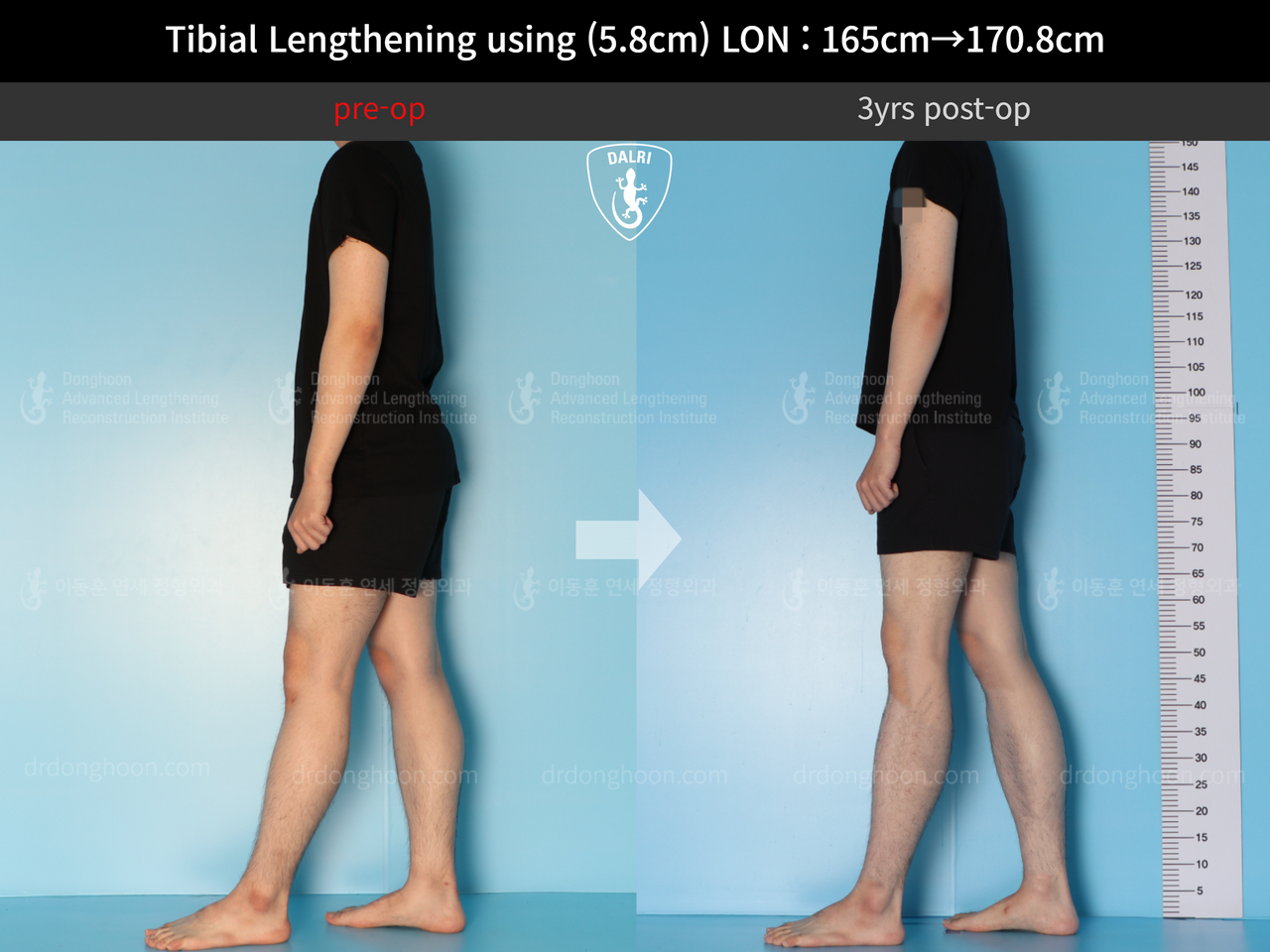 Before and after cll lon, case 12828098, image 3, Dr. Donghoon institute (DALRI)