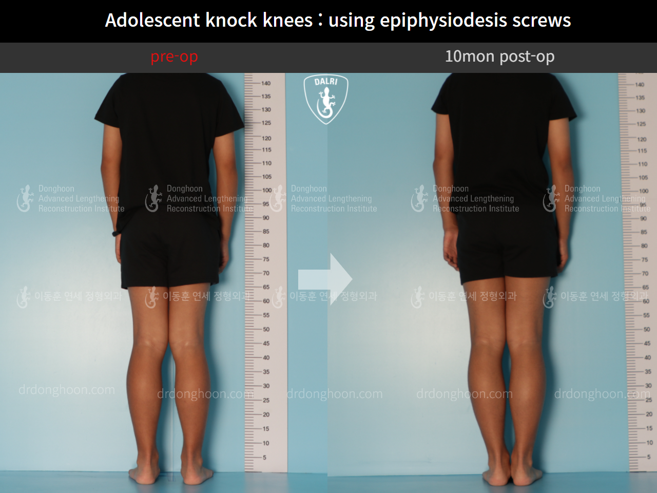 Before and after paediatric & adolescent knock knees, case 11511975, image 2, Dr. Donghoon institute (DALRI)