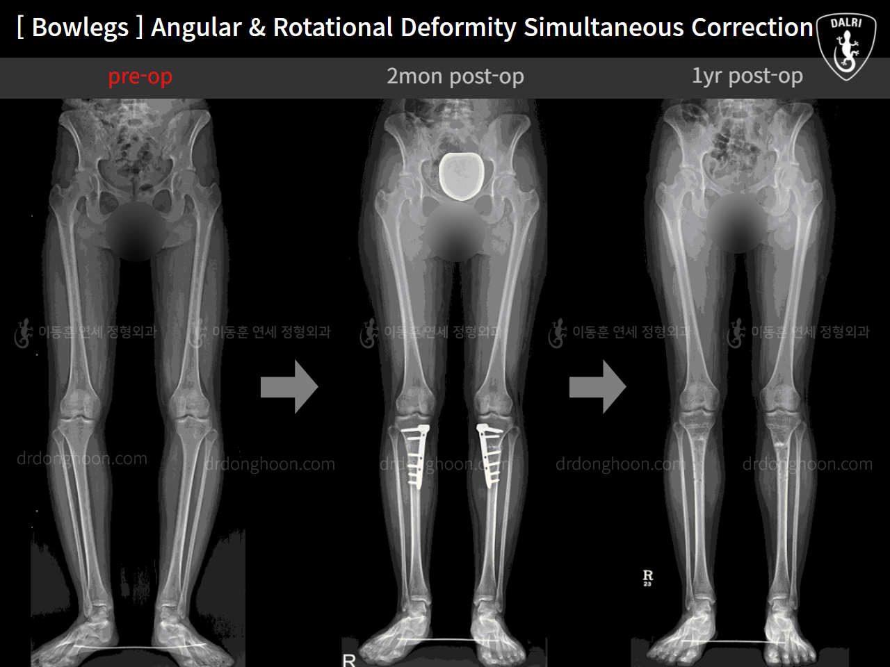 Before and after adult bowlegs, case 9036639, image 5, Dr. Donghoon institute (DALRI)