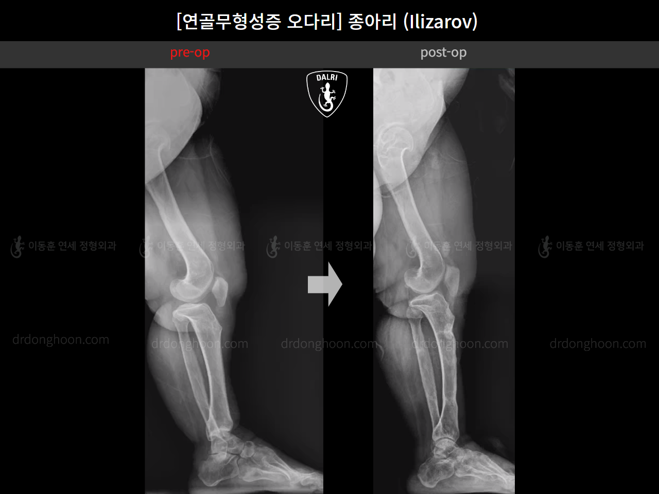 Before and after congenital condition, case 18077774, image 7, Dr. Donghoon institute (DALRI)