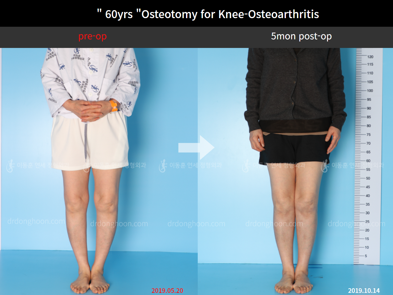 Before and after osteotomy for knee osteoarthritis, case 4586357, image 1, Dr. Donghoon institute (DALRI)